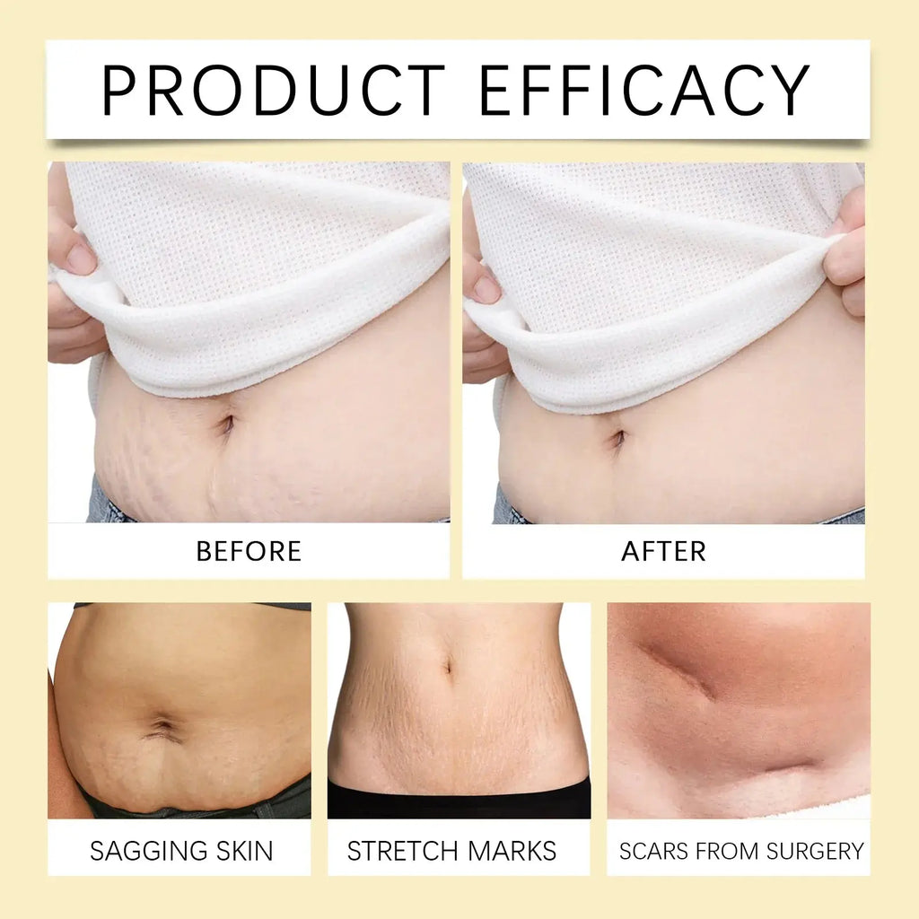 Stretch Mark Lightening Essential Oil Skin Care Cream for Pregnant Women Moisturizing Lifting Firming Skin Slimming Oil 100ml